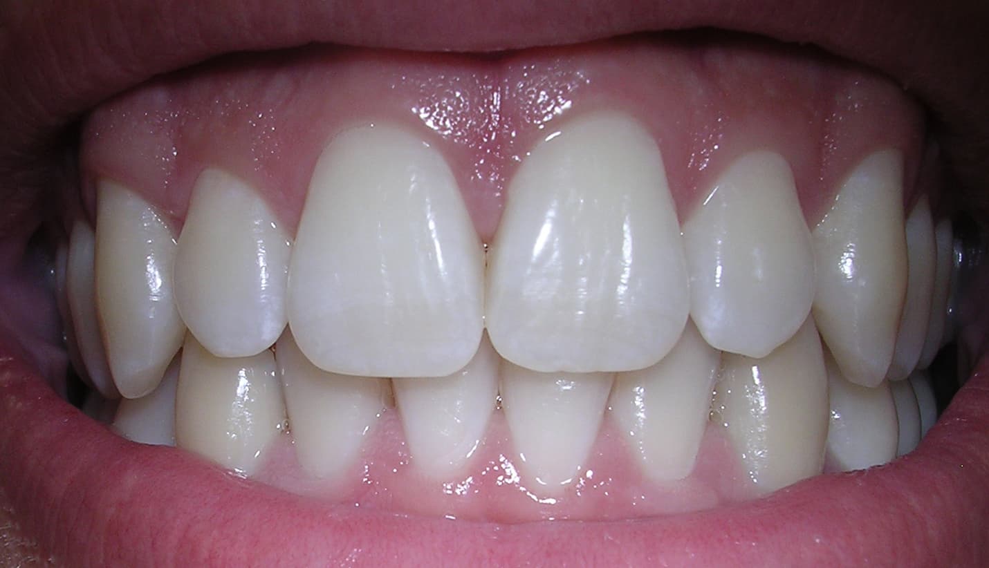 Dent humaine - vue detaillee