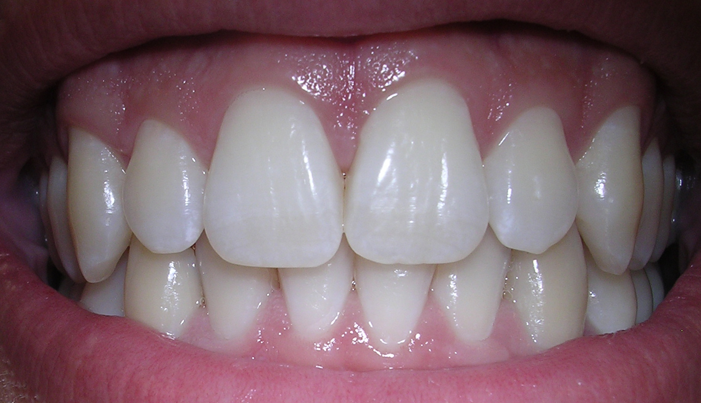 Dent humaine - vue detaillee